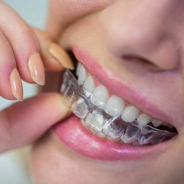 Transparent Plate Treatment